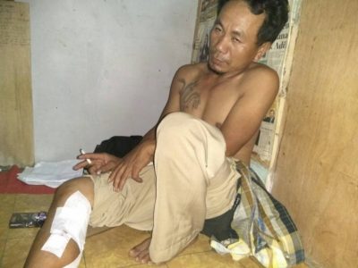 Risal Warga Desa Ambololi Korban Kecelakaan Kerja Di Masjid Al Imran Kabupaten Konsel Saat Menunjukan Lukanya Yang Sudah Mendapatkan Perawatan. FOTO : MAHIDIN