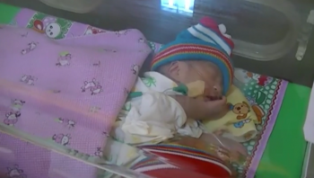 Bayi Kembar Siam Tak Punya Biaya Dirujuk ke RS Dr Soetomo Surabaya